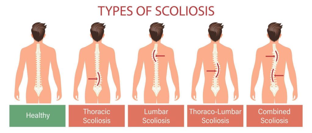 types of scoliosis infographic
