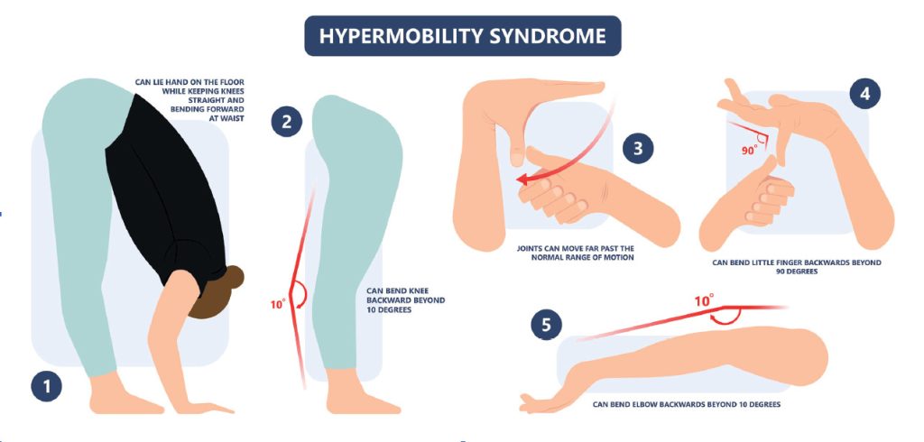Illustration showing signs of hypermobility syndrome: flexible knees, elbows, fingers, and joints beyond normal range.