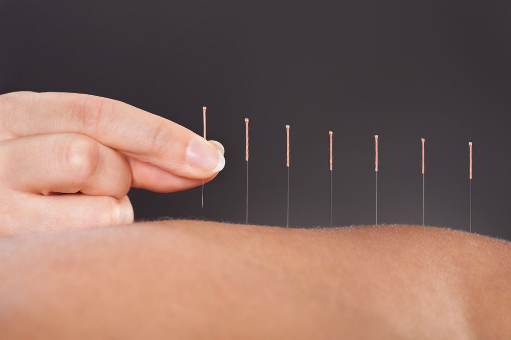 Hand inserting acupuncture needles into skin for therapeutic session. - Premier Therapy Boca Raton Hand inserting acupuncture needles into skin for therapeutic session.
