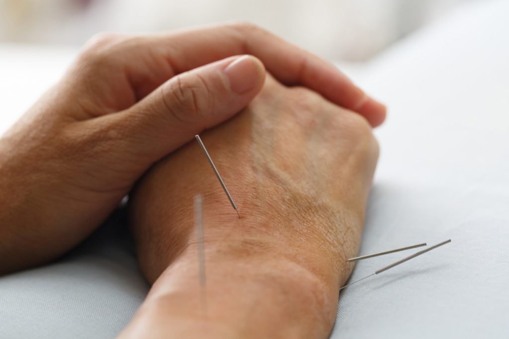 Acupuncture treatment on hand, close-up of needles in skin promoting relaxation and healing. - Premier Therapy Boca Raton Acupuncture treatment on hand, close-up of needles in skin promoting relaxation and healing.
