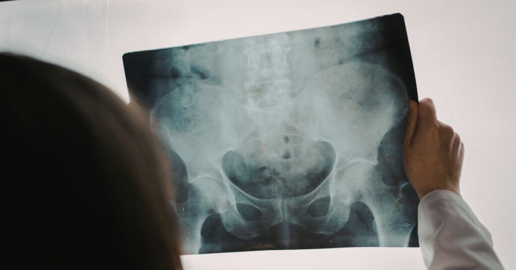 A healthcare professional holding up a pelvic X-ray film to a light source, showing the skeletal structure of the hips and lower spine.